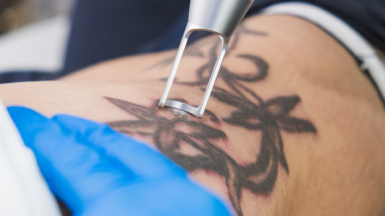 Laser Tattoo Removal: A New Life, A New Skin, No Regrets!