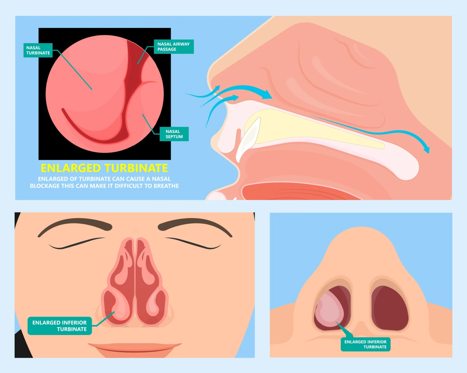 Stuffy Nose